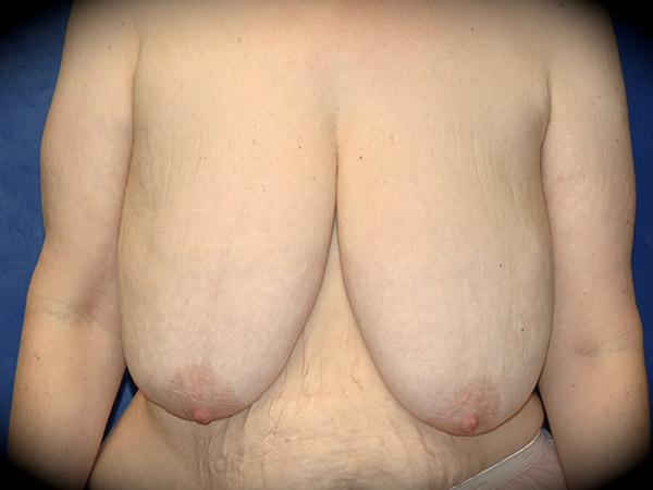 Breast Reduction before at Pasadena Cosmetic Surgery in Pasadena, CA