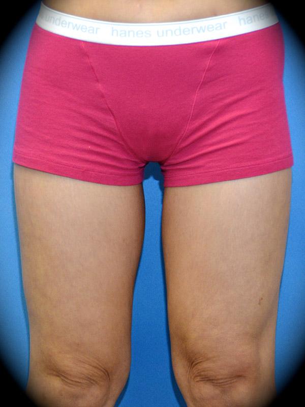 Thigh Lift after at Pasadena Cosmetic Surgery in Pasadena, CA