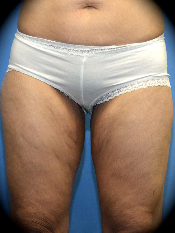 Thigh Lift before at Pasadena Cosmetic Surgery in Pasadena, CA