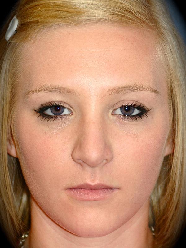 Rhinoplasty after at Pasadena Cosmetic Surgery in Pasadena, CA