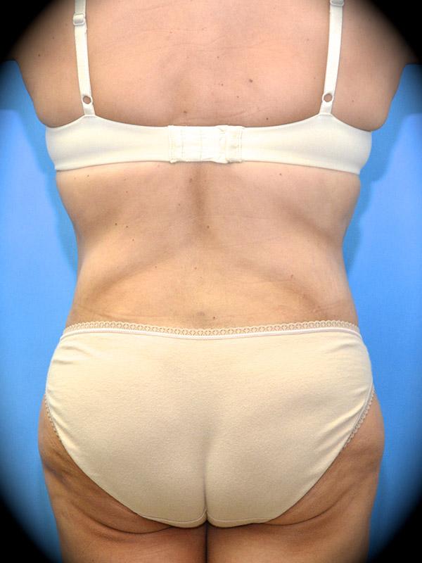 Liposuction after at Pasadena Cosmetic Surgery in Pasadena, CA
