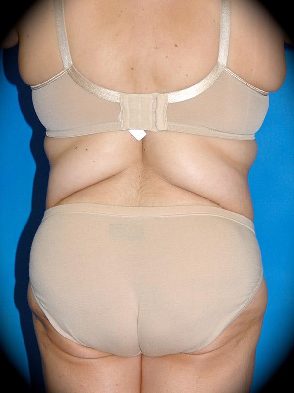 Liposuction before at Pasadena Cosmetic Surgery in Pasadena, CA