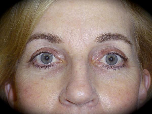 Blepharoplasty after at Pasadena Cosmetic Surgery in Pasadena, CA