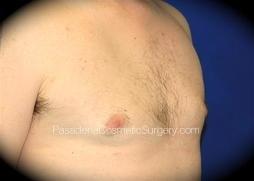Pasadena Cosmetic Surgery gynecomastia after — Pasadena, CA