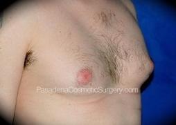 Gynecomastia Surgery before at Pasadena Cosmetic Surgery in Pasadena, CA