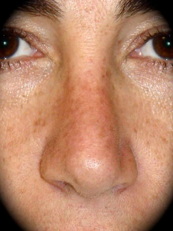 Rhinoplasty after at Pasadena Cosmetic Surgery in Pasadena, CA