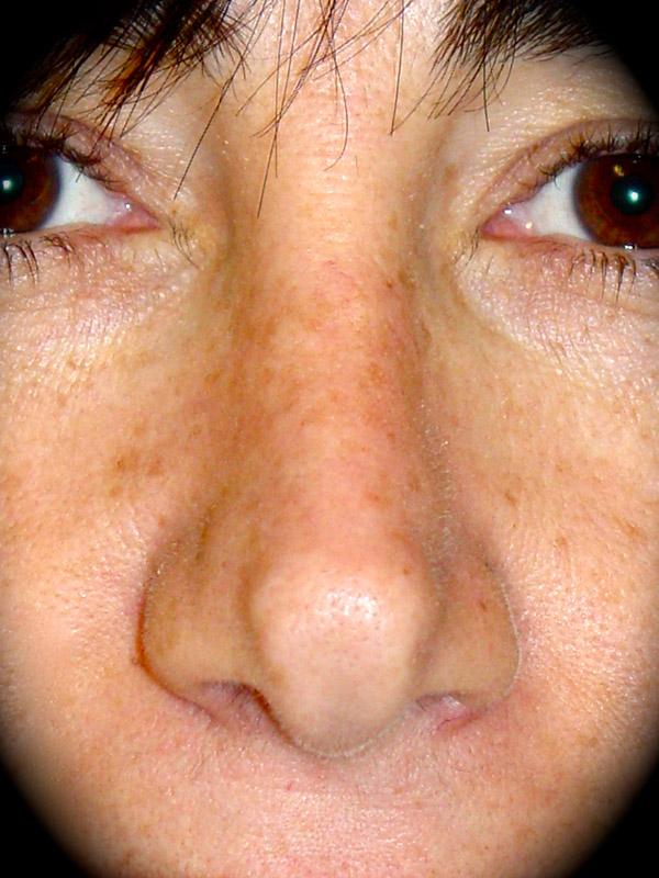 Rhinoplasty before at Pasadena Cosmetic Surgery in Pasadena, CA
