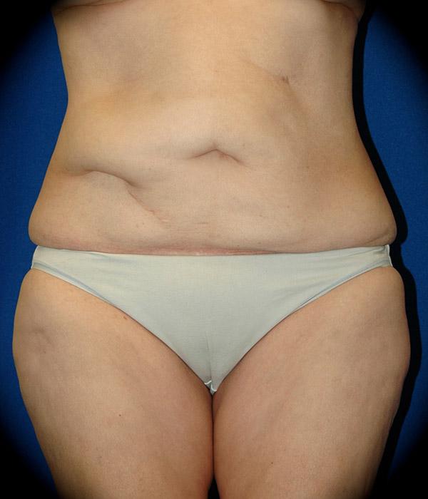 Mini Tummy Tuck before at Pasadena Cosmetic Surgery in Pasadena, CA