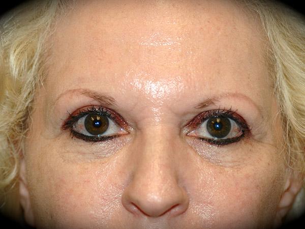 Brow Lift before at Pasadena Cosmetic Surgery in Pasadena, CA