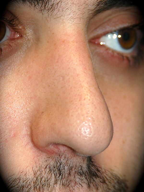 Pasadena Cosmetic Surgery rhinoplasty after — Pasadena, CA