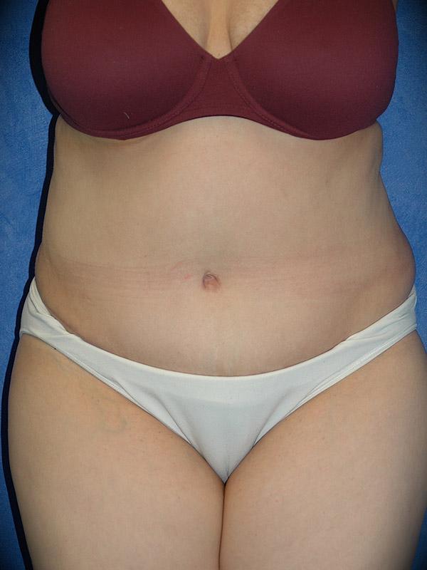 Mini Tummy Tuck after at Pasadena Cosmetic Surgery in Pasadena, CA