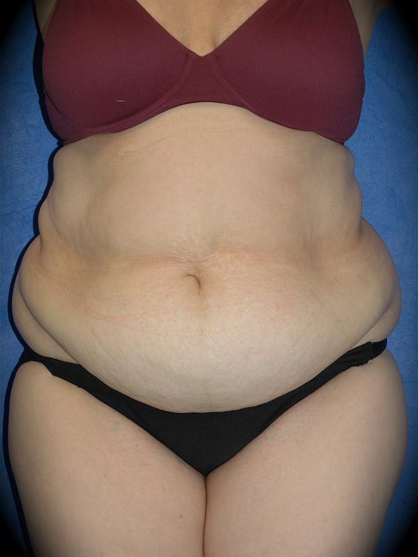 Mini Tummy Tuck before at Pasadena Cosmetic Surgery in Pasadena, CA