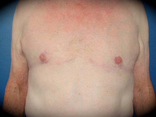 Pasadena Cosmetic Surgery gynecomastia after — Pasadena, CA