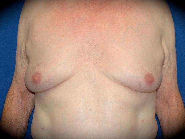 Gynecomastia Surgery before at Pasadena Cosmetic Surgery in Pasadena, CA