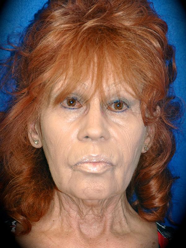 Neck Lift before at Pasadena Cosmetic Surgery in Pasadena, CA