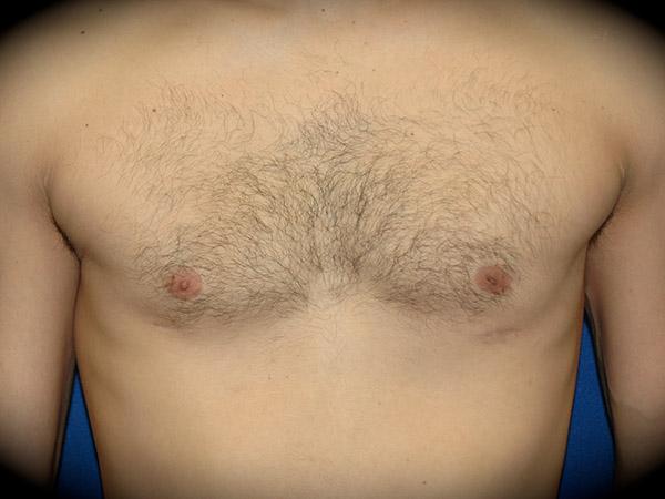 Pasadena Cosmetic Surgery gynecomastia after — Pasadena, CA