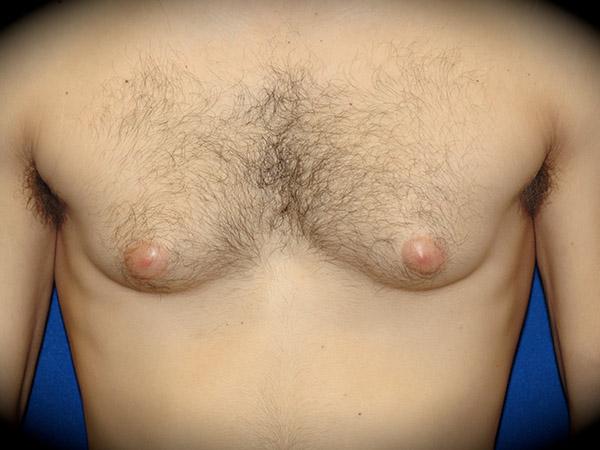 Gynecomastia Surgery before at Pasadena Cosmetic Surgery in Pasadena, CA