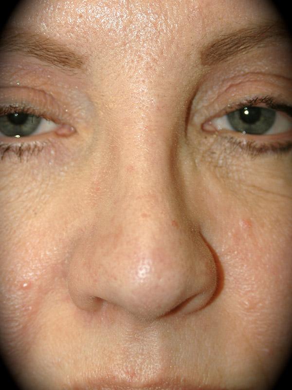 Pasadena Cosmetic Surgery rhinoplasty after — Pasadena, CA