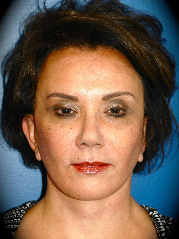 Deep Plane Facelift after at Pasadena Cosmetic Surgery in Pasadena, CA