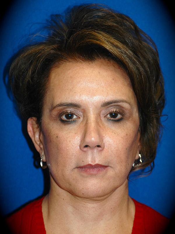Deep Plane Facelift before at Pasadena Cosmetic Surgery in Pasadena, CA