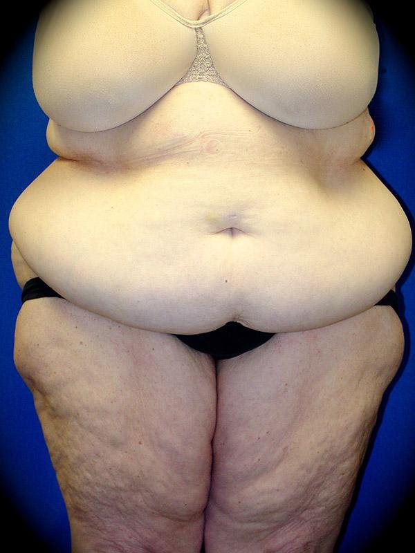 Mini Tummy Tuck before at Pasadena Cosmetic Surgery in Pasadena, CA