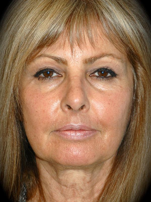 Laser Skin Resurfacing after at Pasadena Cosmetic Surgery in Pasadena, CA