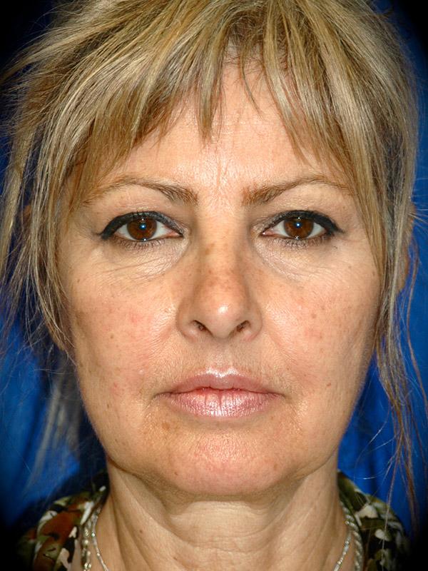Laser Skin Resurfacing before at Pasadena Cosmetic Surgery in Pasadena, CA