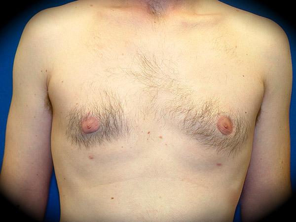Gynecomastia Surgery after at Pasadena Cosmetic Surgery in Pasadena, CA