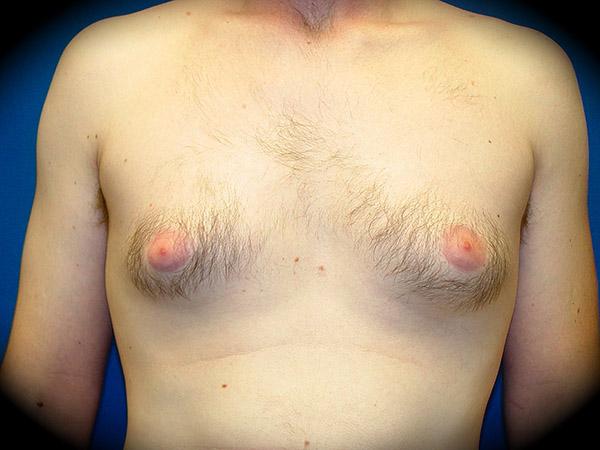 Gynecomastia Surgery before at Pasadena Cosmetic Surgery in Pasadena, CA