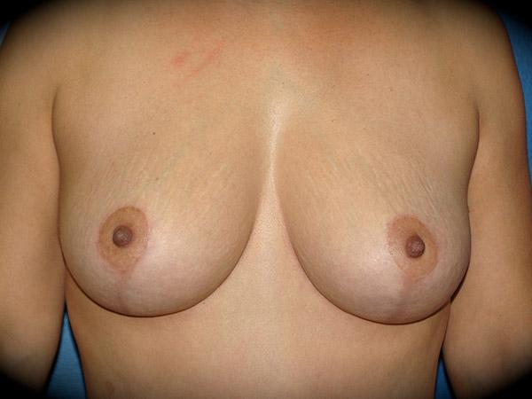 Breast Lift after at Pasadena Cosmetic Surgery in Pasadena, CA