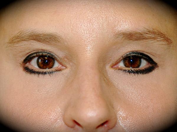Brow Lift after at Pasadena Cosmetic Surgery in Pasadena, CA