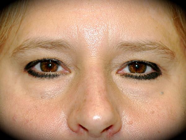 Brow Lift before at Pasadena Cosmetic Surgery in Pasadena, CA