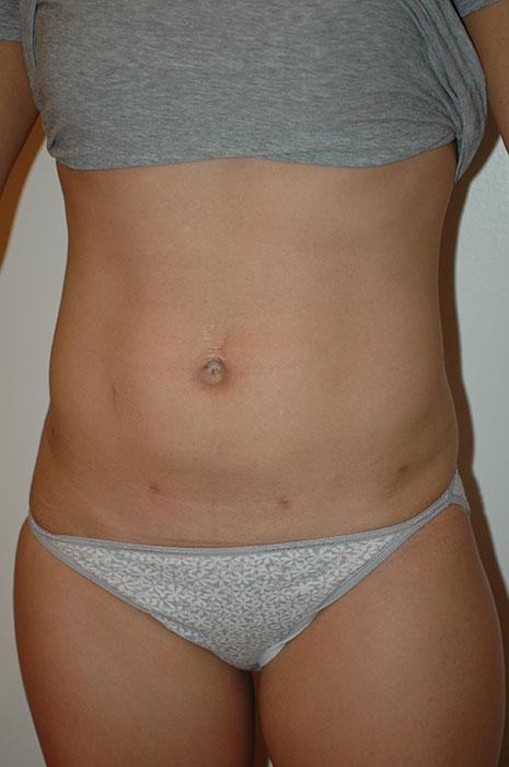 Gartner Plastic Surgery liposuction after — Paramus, NJ