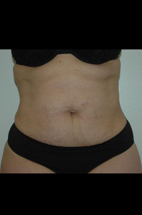 Gartner Plastic Surgery liposuction after — Paramus, NJ