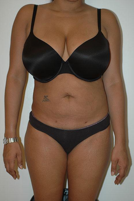 Gartner Plastic Surgery liposuction after — Paramus, NJ