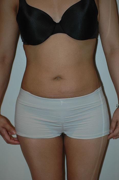 Gartner Plastic Surgery liposuction after — Paramus, NJ