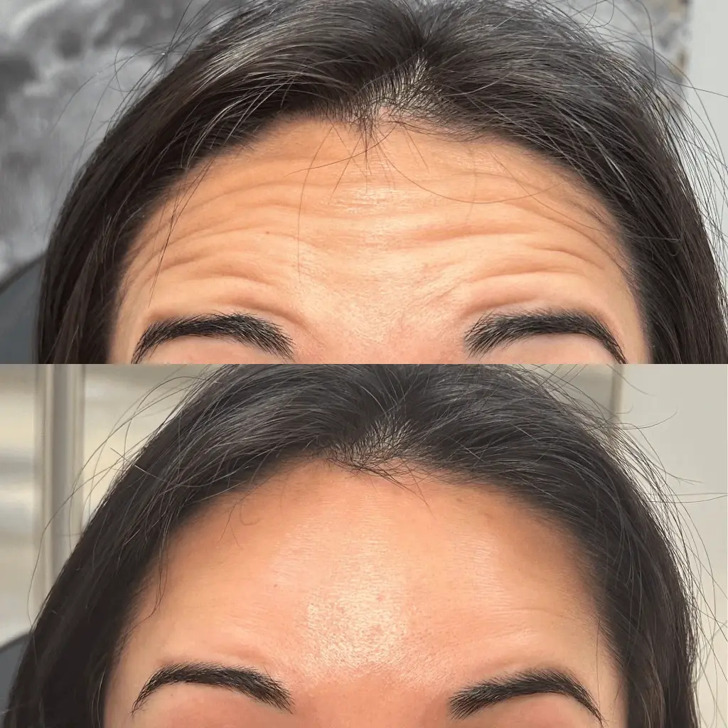 Injections by Kylie botox result — Lehi, UT