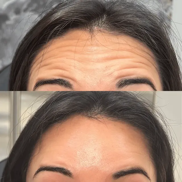 Botox result at Injections by Kylie in Lehi, UT