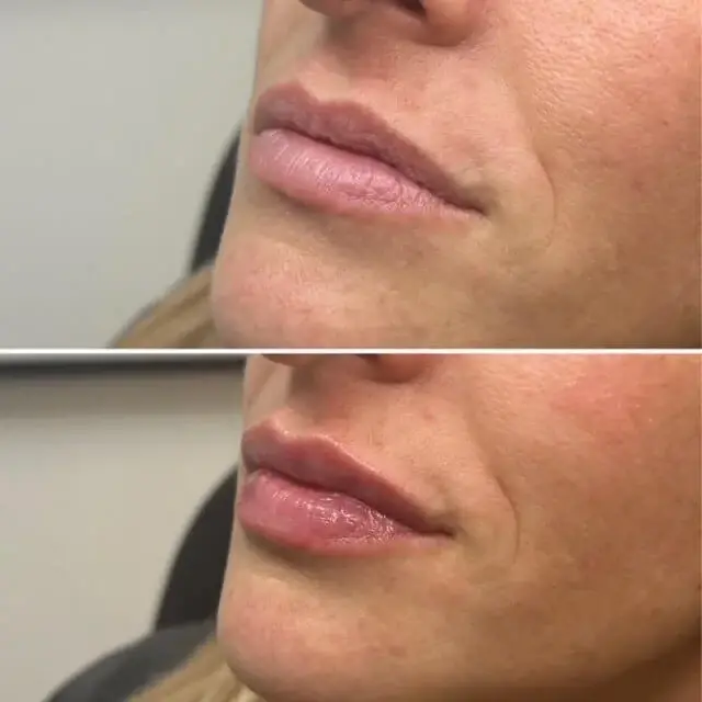 Injections by Kylie lip filler result — Lehi, UT