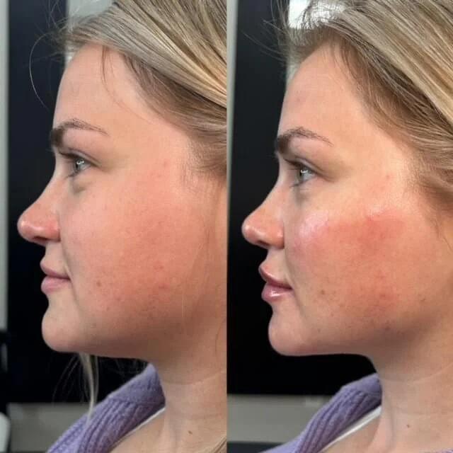 Injections by Kylie cheek filler result — Lehi, UT