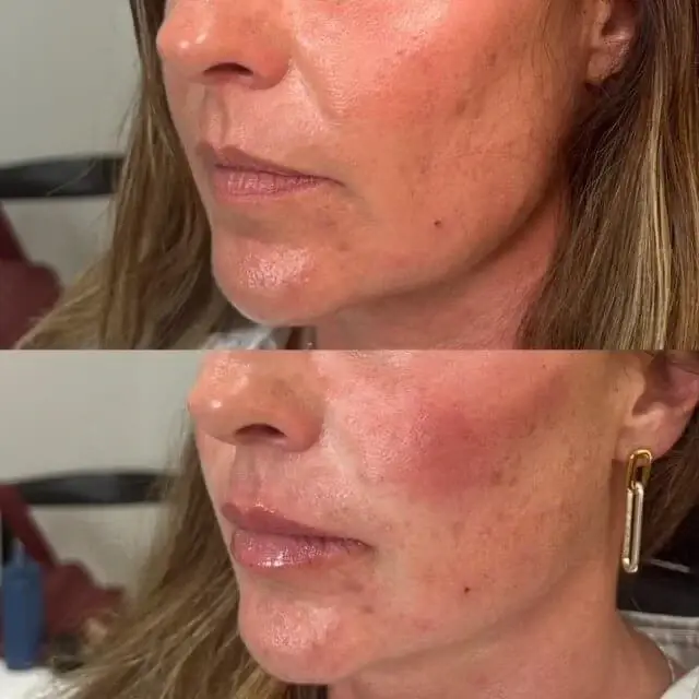 Injections by Kylie lip filler result — Lehi, UT