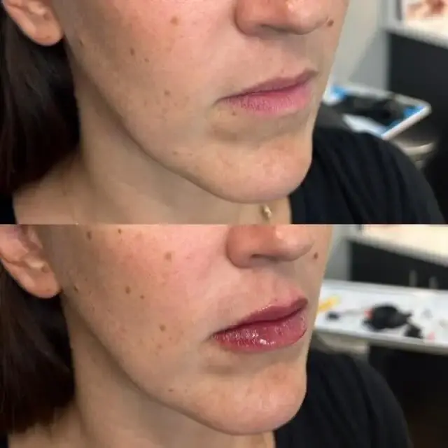 Lip Filler result at Injections by Kylie in Lehi, UT