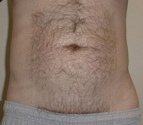 Edward Berzin, MD liposuction after — Houston, TX