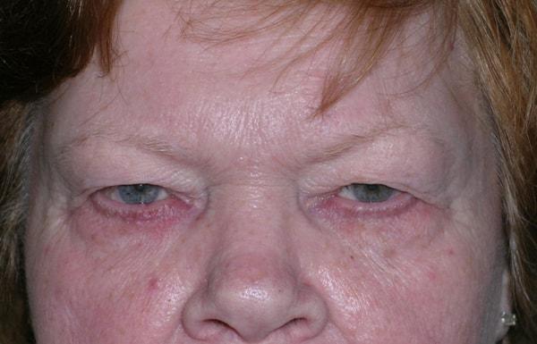 Brow Lift before at Edward Berzin, MD in Houston, TX