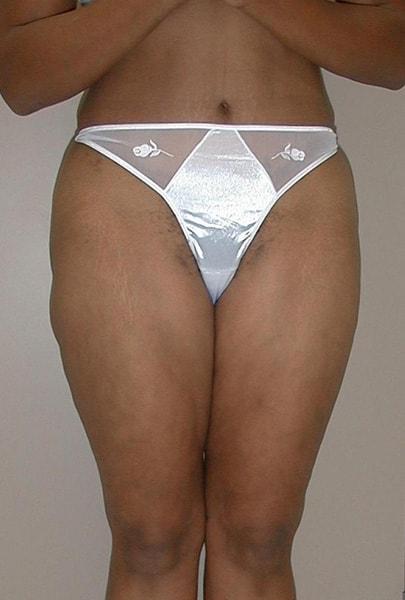 Edward Berzin, MD liposuction after — Houston, TX