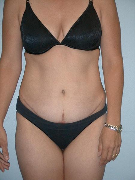 Edward Berzin, MD tummy tuck after — Houston, TX