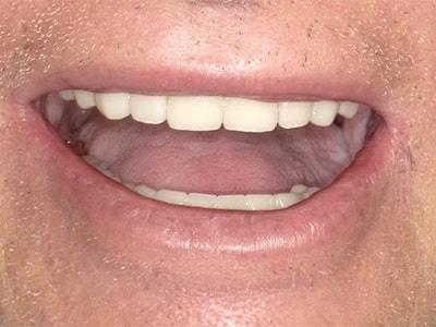 Smile Makeover after at Pomerado Cosmetic Dentistry in Poway, CA
