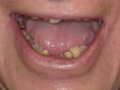 Smile Makeover before at Pomerado Cosmetic Dentistry in Poway, CA