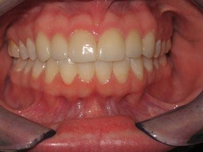 Pomerado Cosmetic Dentistry veneers after — Poway, CA