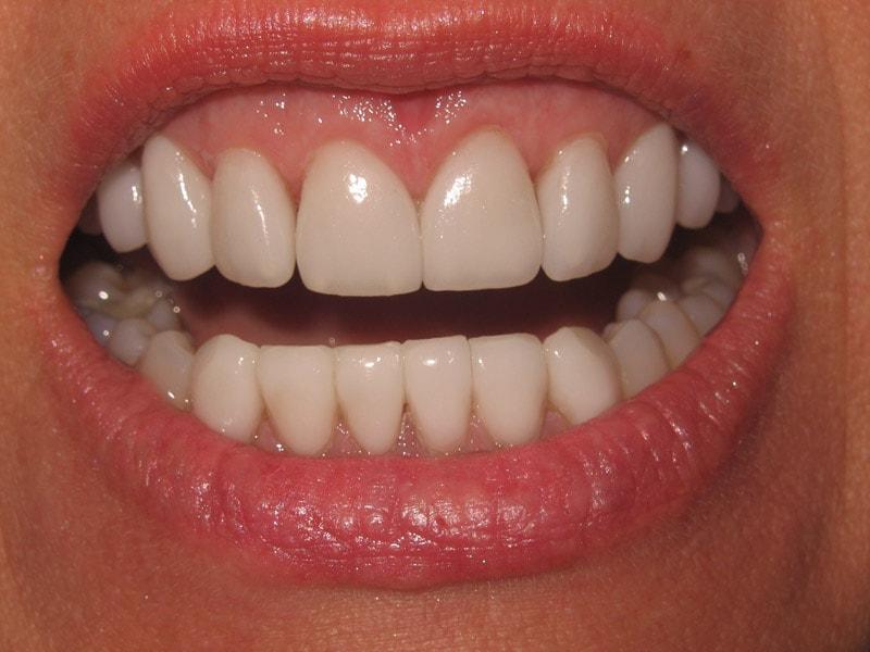 Pomerado Cosmetic Dentistry veneers after — Poway, CA
